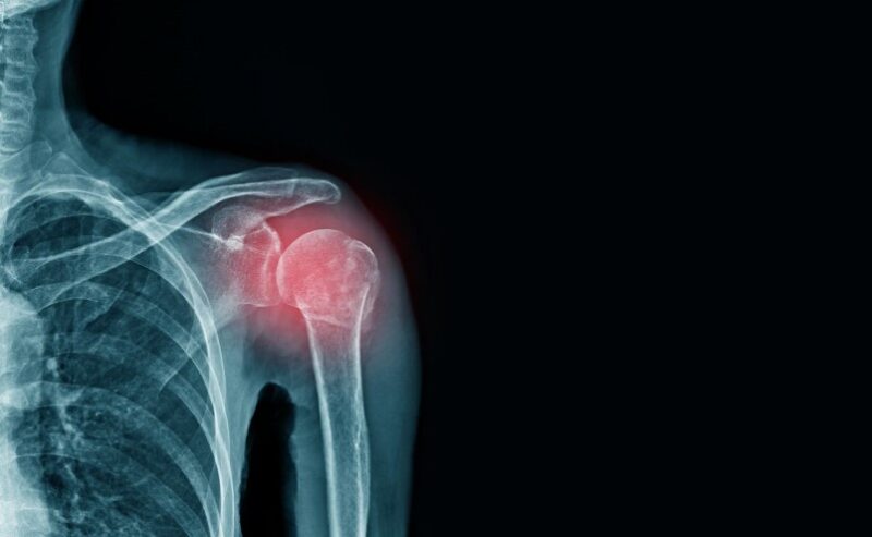 Diagnostic image showcasing the shoulder joint